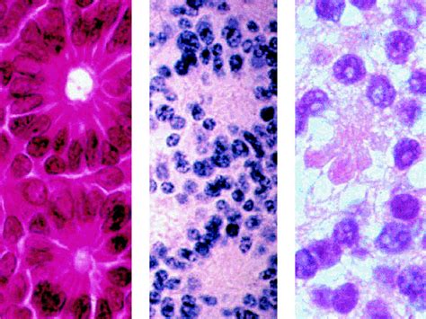 Check spelling or type a new query. 7 - Retinal Tumors | The Wills Eye Hospital Atlas of ...