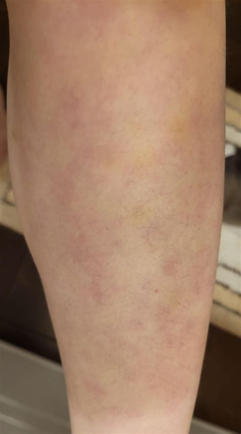 Weird Bruising On Legs During A Flare R Ankylosingspondylitis