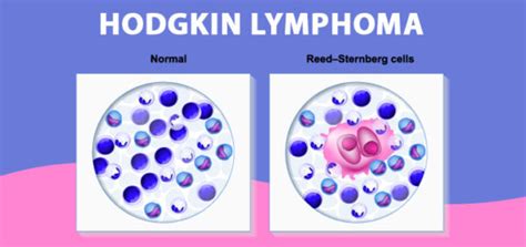 Hodgkin Lymphoma Causes Symptoms Diagnosis And Treatment Healthinfonetwork
