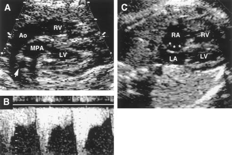 Prenatal Features Of Ductus Arteriosus Constriction And Restrictive
