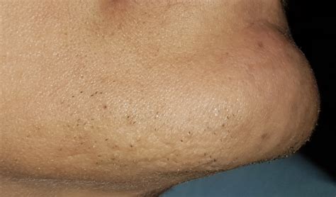 Hair growth on a woman, transgender or not, can be highly stigmatizing and very embarrassing. Question about chin hair and scarring post electrolysis ...
