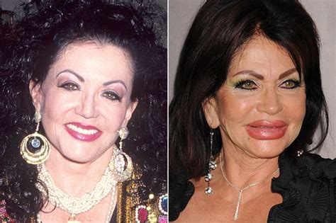 Celebs Who Are Unrecognizable After Having Plastic Surgery Page 12 Of