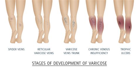 Venous Insufficiency Is A Disease Process Which Can Affect All Age Groups