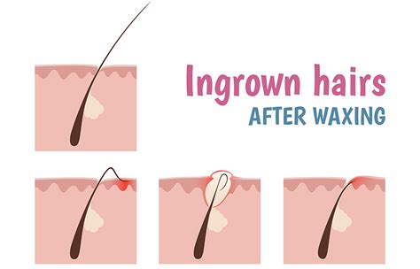How To Get Rid Of Ingrown Hairs