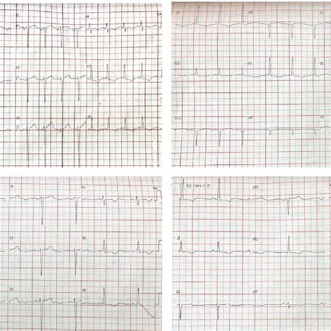 Twelve Lead Electrocardiogram Showing Different Qt Intervals A