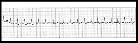 Float Nurse Practice Ekg Strips 382