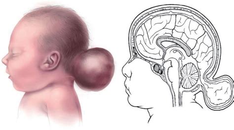 Mengenal Penyakit Langka Encephalocele Gejala Penyebab Dan