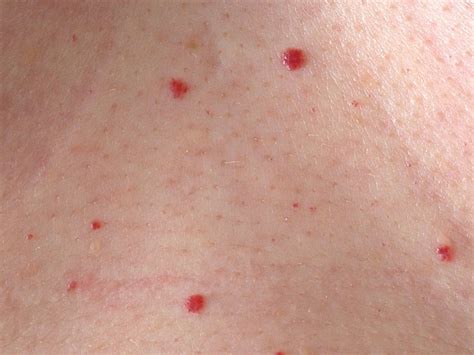 Cherry Angioma Images Pictures Photos