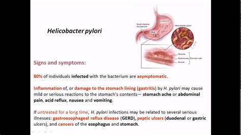 Helicobacter Pylori Signs And Symptoms YouTube