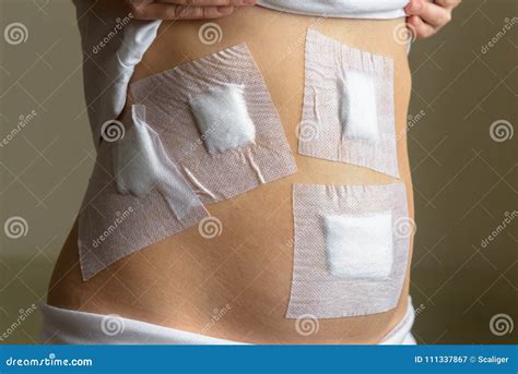 Young Woman`s Belly After Operation By Laparoscopy In A Clinic Stock