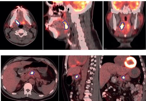 Images Of Patients With Top Squamous Cell Cancer Of The Oropharynx