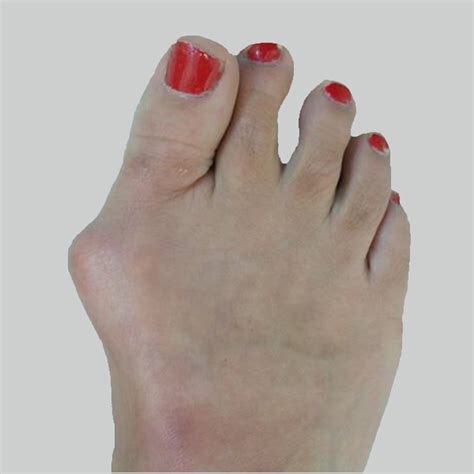 Swollen Big Toe ~ Big Toe Swollen It Is A Chronic Disease Can Put