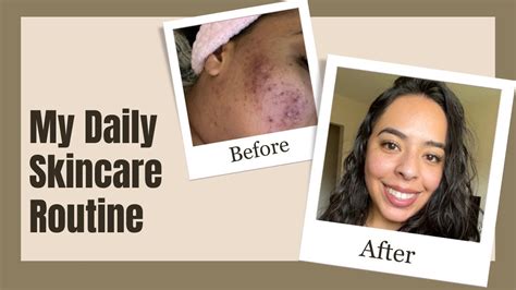 How I Cleared My Cystic Acne Daily Skin Care Routine Youtube