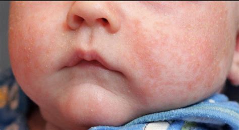 Skin Problems Your Baby May Suffer From My Doctor My Guide