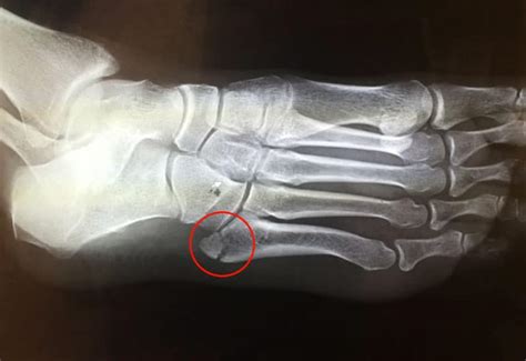 5th Metatarsal Stress Fracture Treatment And Management