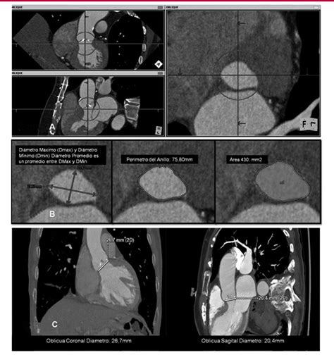 Figure 3 From Role Of Advanced Cardiac Imaging In Transcatheter Aortic