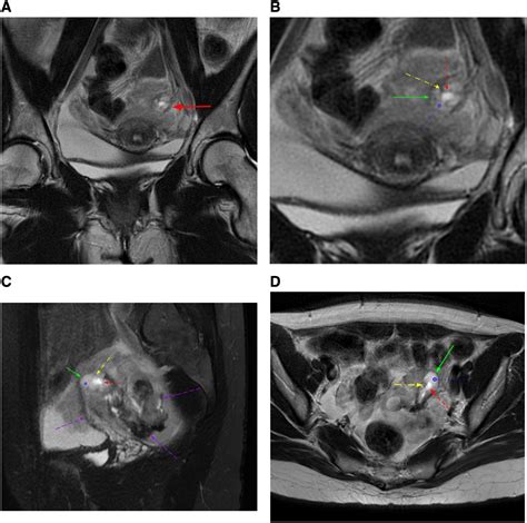 magnetic resonance imaging of tubal ectopic pregnancy correlation with intraoperative findings