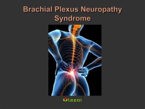 Brachial Plexus Neuropathy Syndrome Ppt