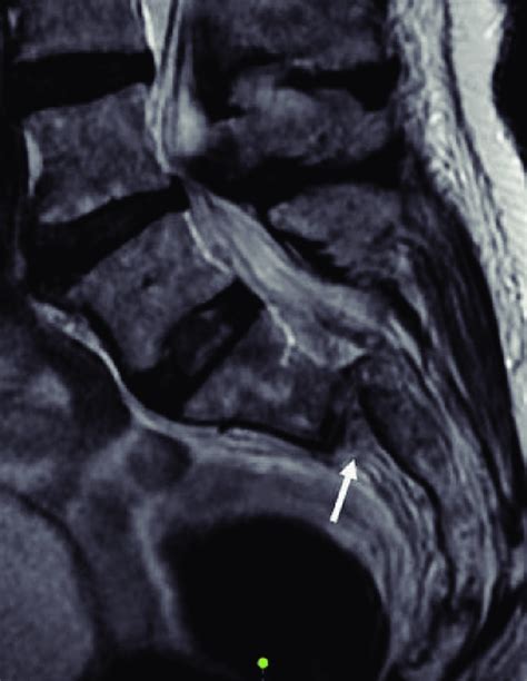 Sagittal Dislocation Of Type C3 Fracture In Magnetic Resonance Imaging