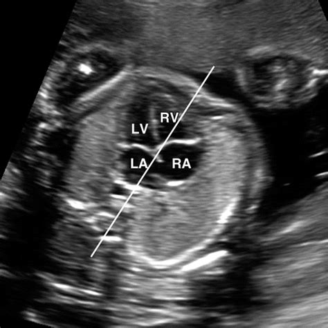 Normal Fetal Heart Ultrasound