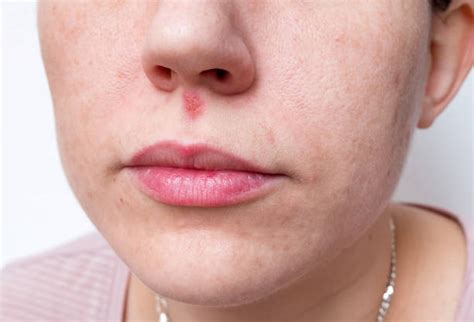 Herpes In Women Pic Stock Photos Pictures And Royalty Free Images Istock