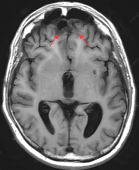 Chronic Post Traumatic Brain Injury Mri Stock Image C0306066