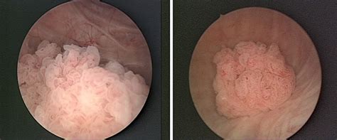 Bladder cancer is caused by cells that mutate (change) and begin to grow in an uncontrolled way. modern surgery: Bladder Cancer Facts