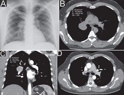 Chest Radiography A Showing Ovoid Opacity In The Right Hilar