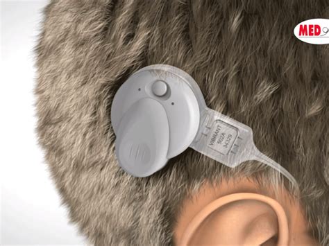 Vibrant Soundbridge Middle Ear Implant System For Hearing Loss Video