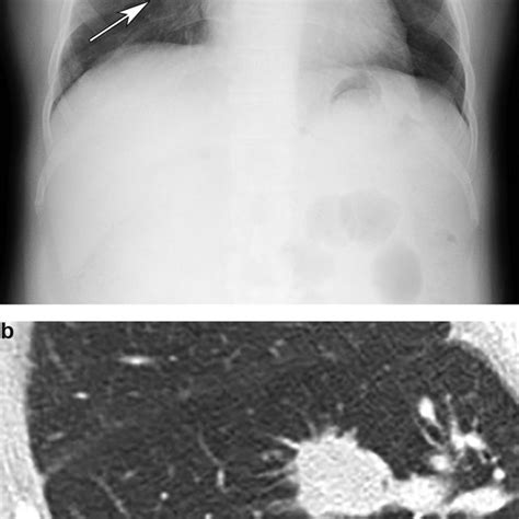 Chest X Ray Showing Multiple Relatively Thick Walled Cystic Air Spaces