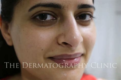 Beauty Spot Tattoo The Dermatography Clinic