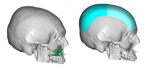 Custom Forehead Implants Eppley Custom Facial Implants