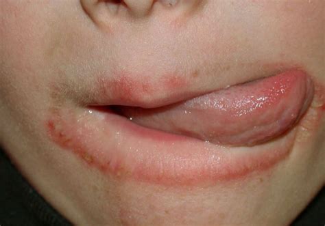 The sensitization phase and the elicitation phase. Lip Eczema Causes, Treatment and Relief Remedies ...