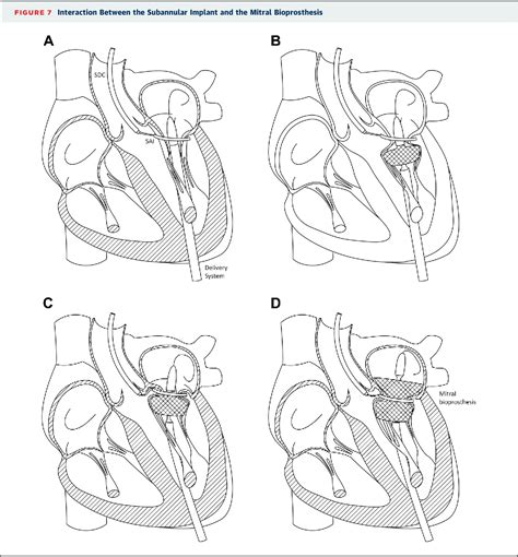 Figure 1 From Transcatheter Mitral Valve Implantation Using The