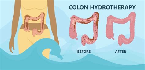 does colon hydrotherapy work behind the risks vs benefits