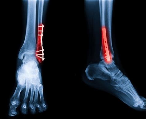 What Should I Expect From Ankle Fracture Surgery And Recovery Eugene