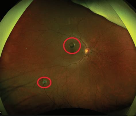 Silicone Oil Droplets After Bevacizumab Intravitreal Injection Retina