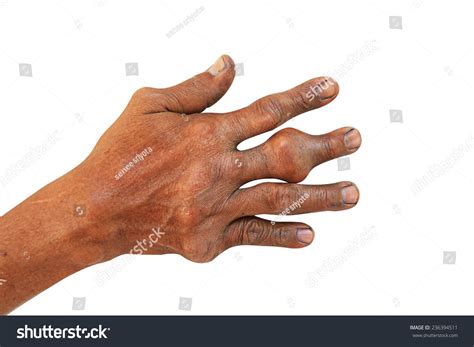 Hand And Fingers Of Patient Of Gout Isolated On White With Path Stock
