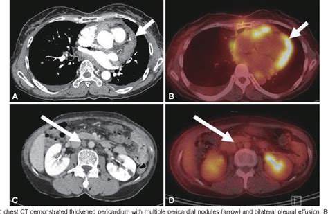 Figure 2 From A Case Of Malignant Pericardial Mesothelioma With