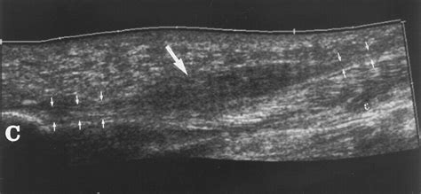 Sonography Of Plantar Fibromatosis Ajr