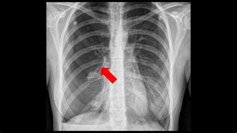 The holes in the lungs present the clinical picture of a lung emphysema with a chronic shortness note: Spontaneous Pneumothorax | Children's Hospital of Philadelphia