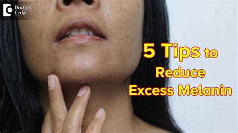 5 TIPS TO REDUCE EXCESS MELANIN Reduce Melanin In Body Permanently Dr