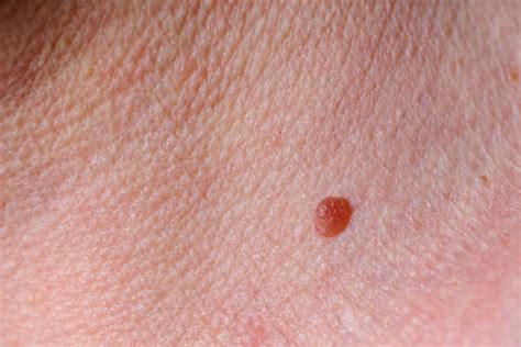 9 Sneaky Warning Signs Of Melanoma You Might Miss