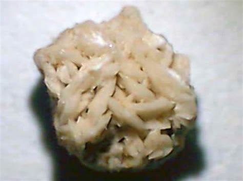 Kidney Stone Containing Calcium Oxalate And Uric Acid Crystals