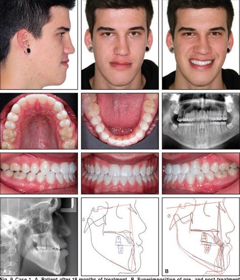 Figure 2 From Nonsurgical Correction Of Severe Skeletal Class Iii
