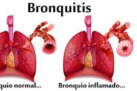Apunte La Bronquitis Y Los Remedios Para Tratarla