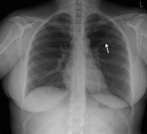 Congenital Segmental Bronchial Atresia In A Young Female Patient With