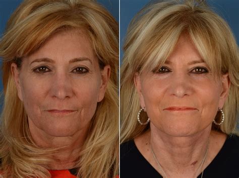 The Uplift™ Lower Face And Neck Lift Photos Naples Fl Patient 11873