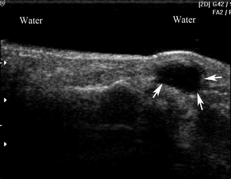 Skin Abscess Ultrasound