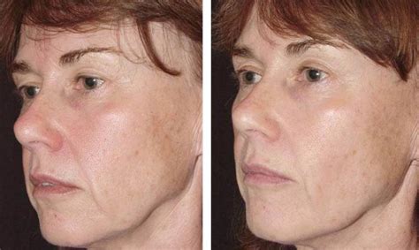 Thermage Sydney Non Surgical Jaw Skin Tightening Infinity